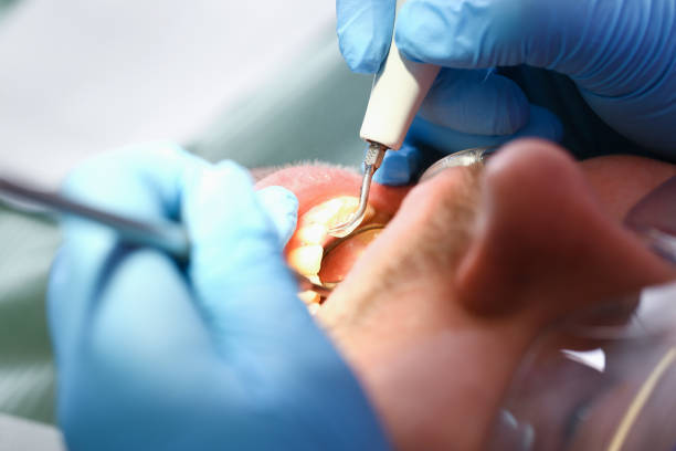 Best Emergency Treatment for Dental Infections or Abscesses in Rouses Point, NY