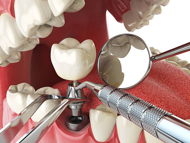 Best Emergency Treatment for Dental Infections or Abscesses in Rouses Point, NY
